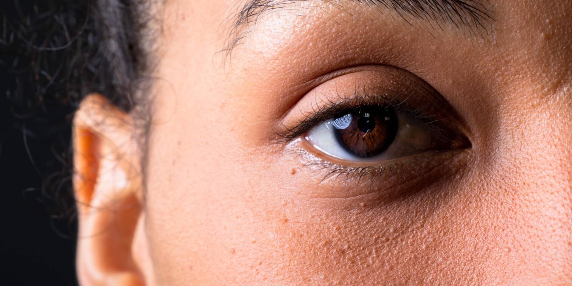 Close-up of under-eye area showing dark circles and uneven skin tone