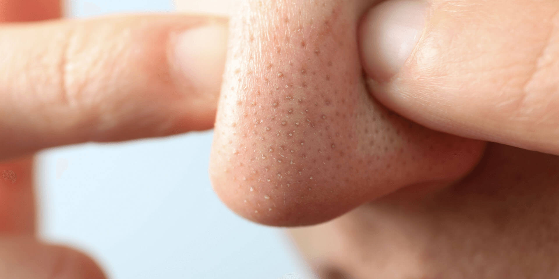 Close-up of nose with visible blackheads and clogged pores squeezed between two fingers