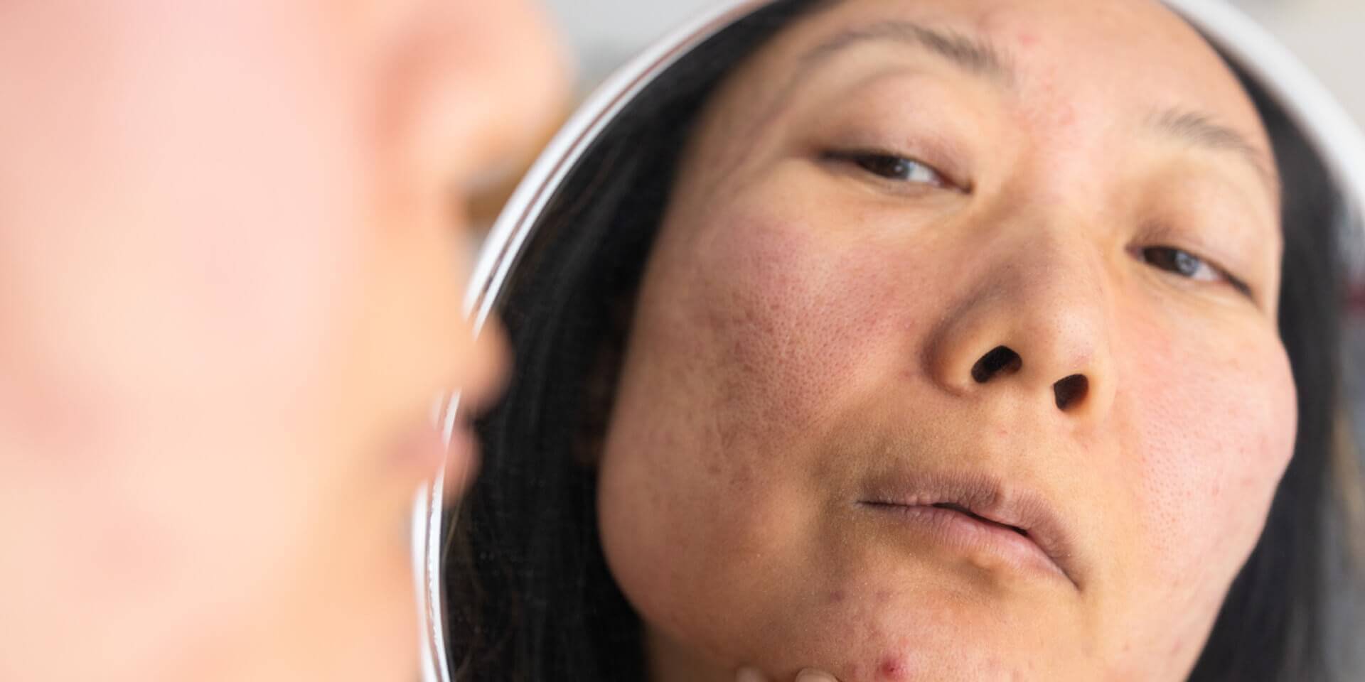 Close-up of face reflected in a mirror showing visible skin texture and small blemishes  