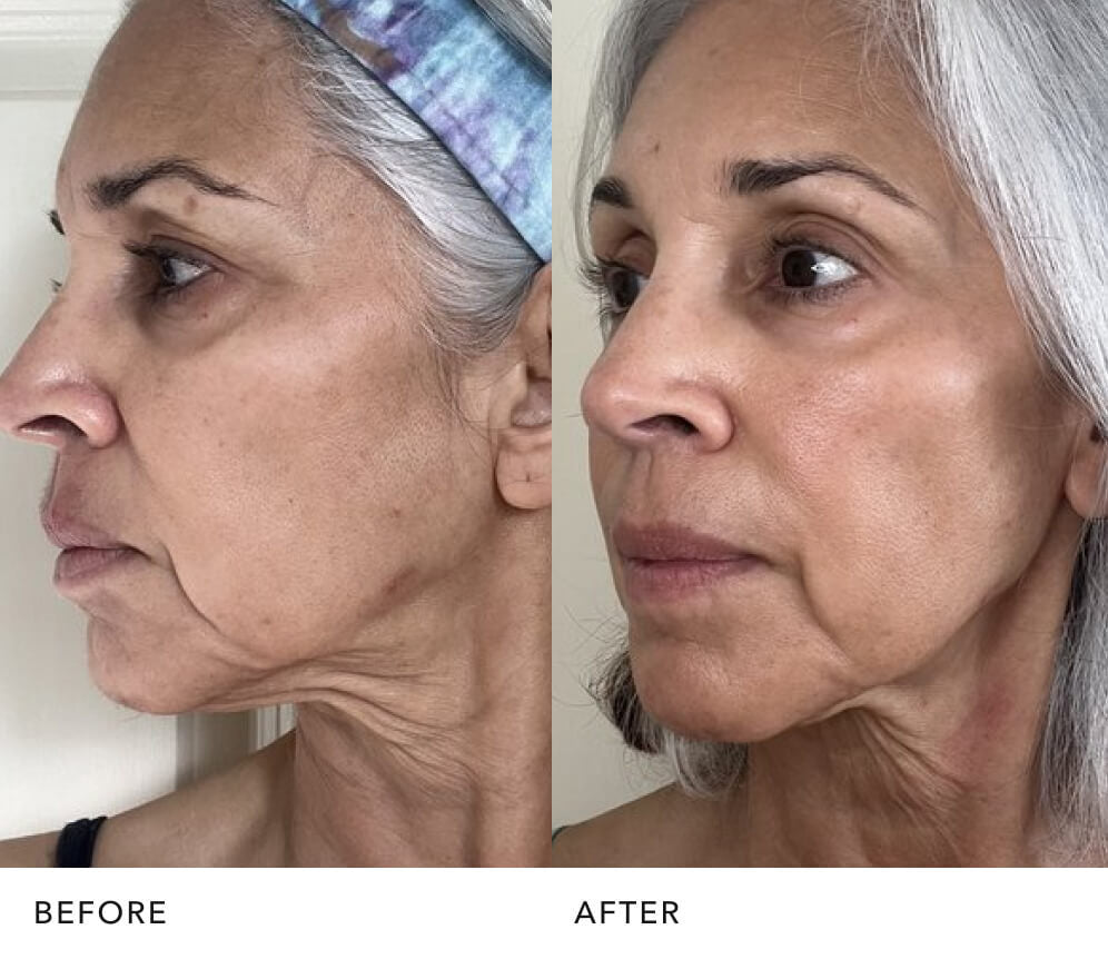 Before and after showing brighter, firmer skin with SK‑II PITERA™ Essence