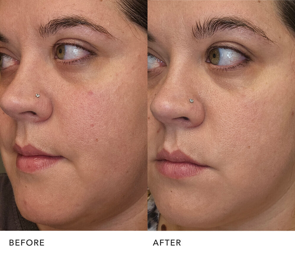 Before and after comparison of skin texture appearance using SK‑II PITERA™ Facial Treatment Essence