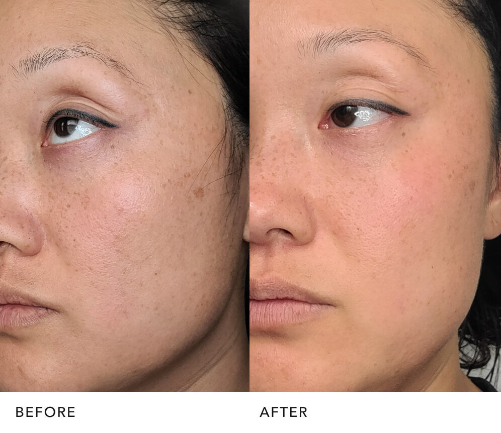 Before and after skin improvement with PITERA™ essence: Radiant Looking Skin