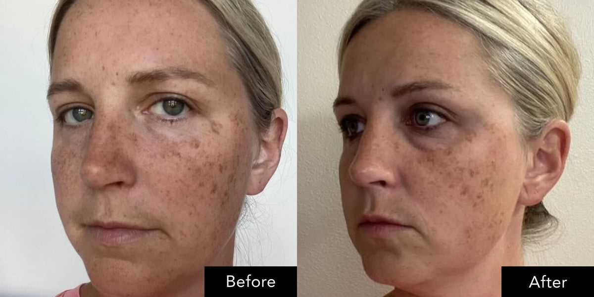 Before and after facial close‑up comparison associated with SK‑II Facial Treatment Essence
 