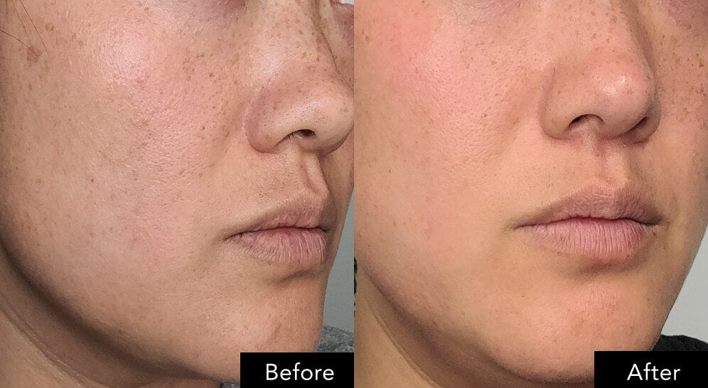 Before and after close-up of a face showing changes in skin appearance on facial treatment essence