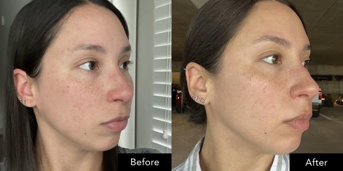 Close‑up side profile images shown before and after use of SK‑II skincare products.