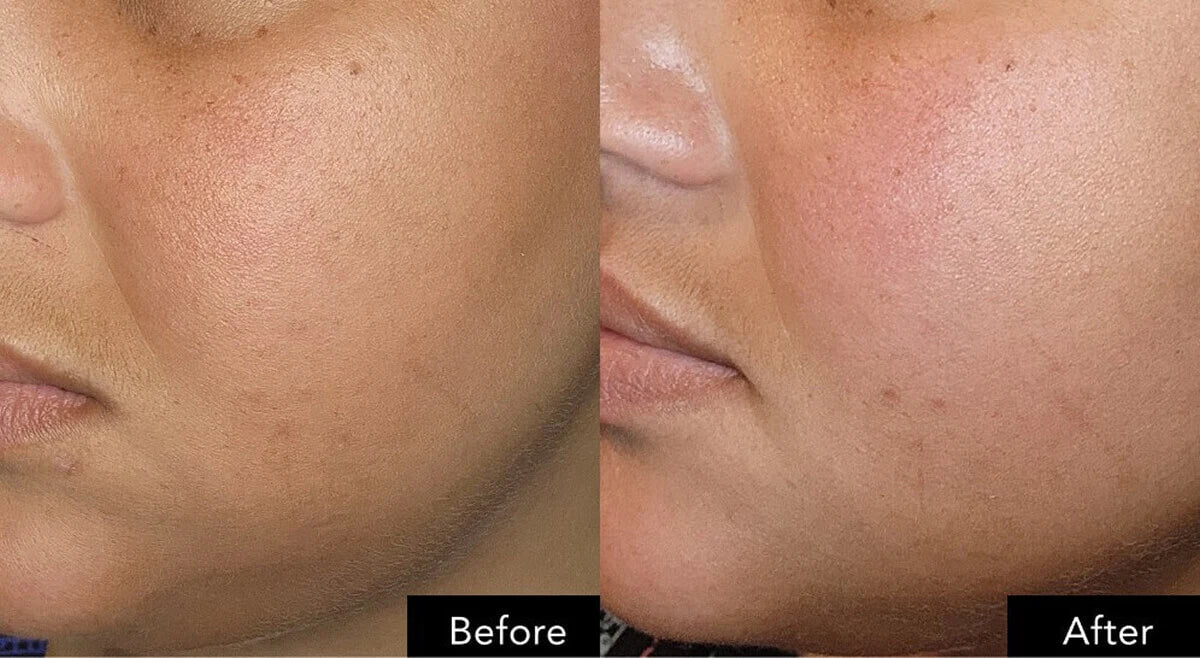 Before and after close-up of a cheek showing visible texture and tone differences