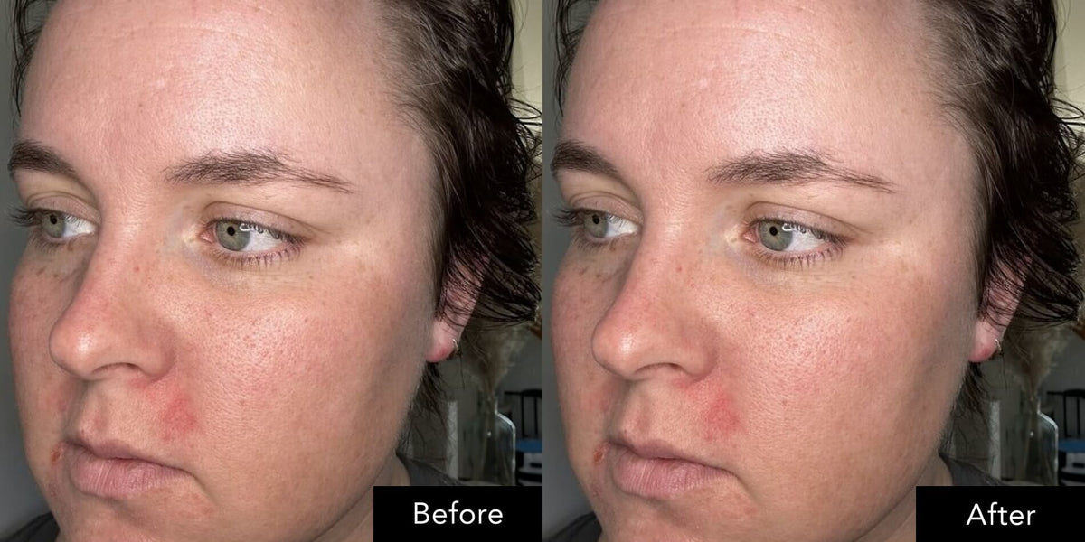Close‑up facial skin shown before and after use of an SK‑II anti‑aging skincare routine.