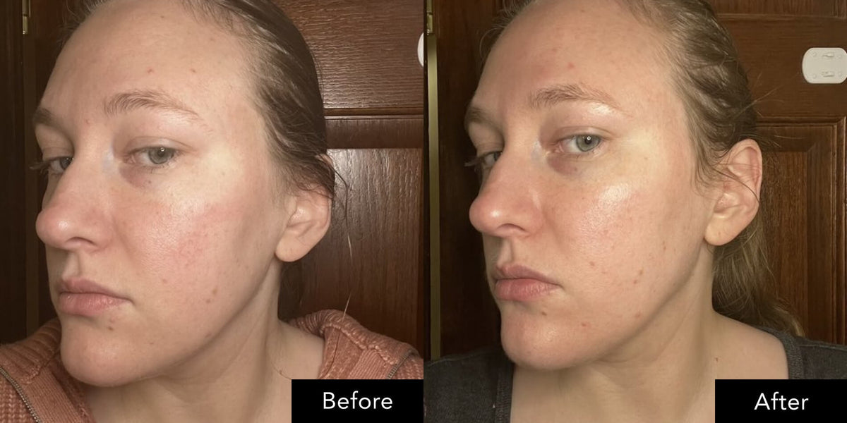 Side‑by‑side face images showing appearance before and after use of SK‑II skincare routine.