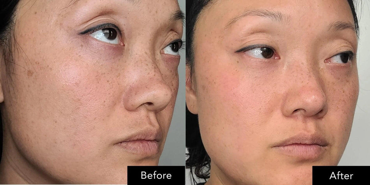 Close‑up face images shown before and after application of SK‑II Pitera Youth Essentials Kit.
 
