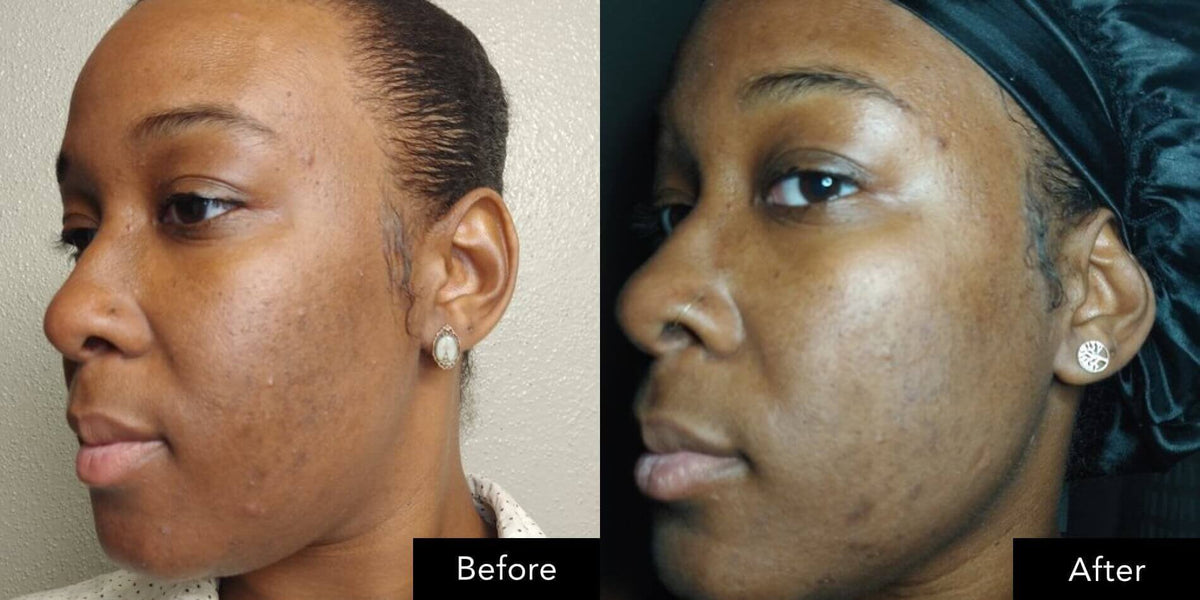 Side‑by‑side facial close‑up images before and after associated with SK‑II essence use
 