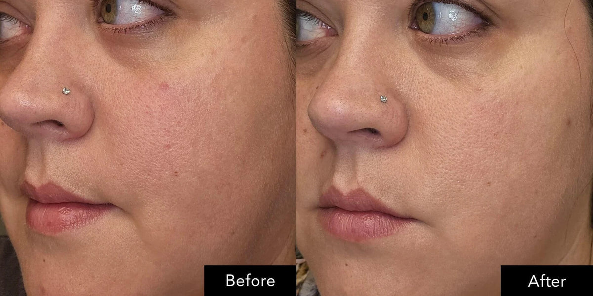 SK‑II Pitera Ultimate Aura Essentials Kit before and after face close‑up showing cheek area.