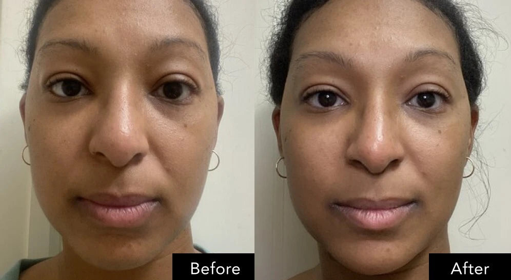 Front-facing face displayed in paired images to visually compare changes in skin texture